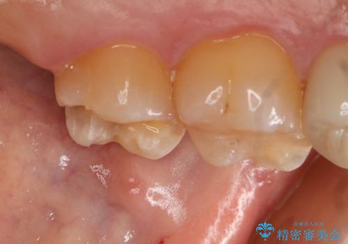 銀歯のやり変え希望 セラミックインレーの治療中