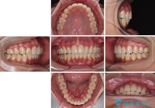 深い咬み合わせと前歯のデコボコ ワイヤー装置での抜歯矯正の治療後