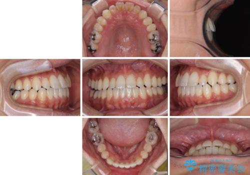 内側に引っ込んだ歯を治したい インビザラインの矯正治療の治療後