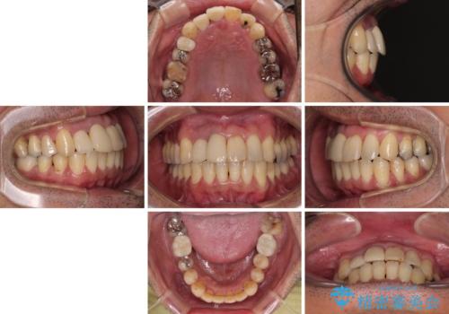 隠れている前歯 インビザライン矯正治療と前歯のセラミック治療の治療後