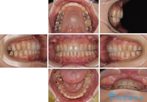 ディープバイトと前歯のデコボコ インビザラインによる矯正治療の治療前