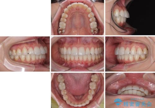 上下前歯のデコボコ ワイヤー装置で楽ちん矯正治療の治療後