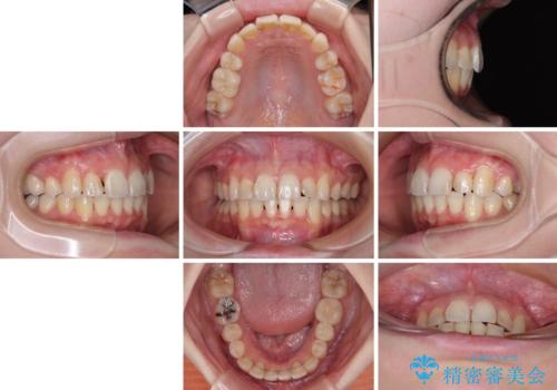 【モニター】デコボコ前歯を治したい ワイヤー装置での抜歯矯正治療の治療後