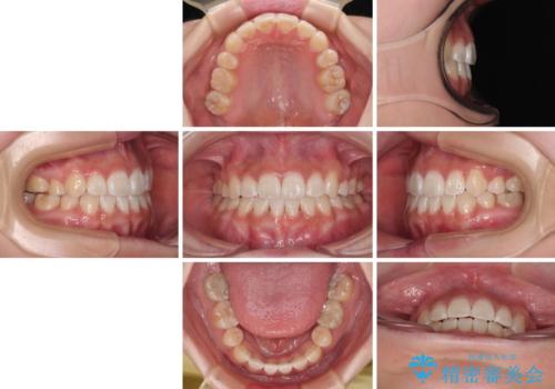 上下非接触の前歯 口元の突出感を改善する抜歯矯正の治療後