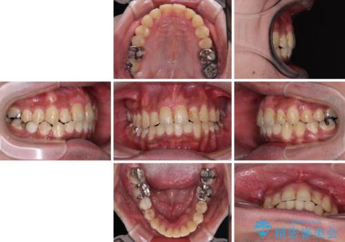 【モニター】飛び出した上の前歯 非抜歯矯正で整った口元にの治療後