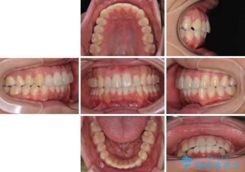 前方に捻れた前歯を治したい インビザライン矯正治療の治療後