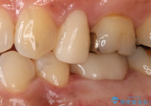 銀歯を白くしたい セラミックインレーの治療後