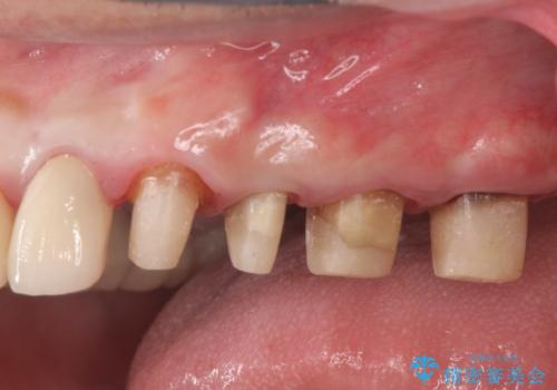 虫歯だらけの歯を治療したいの治療中