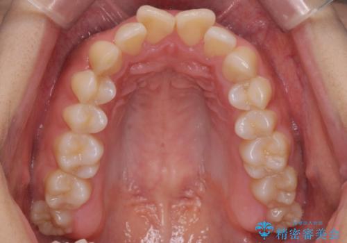 出っ歯の治療 抜かずに 短期間で目立たない治療の治療前