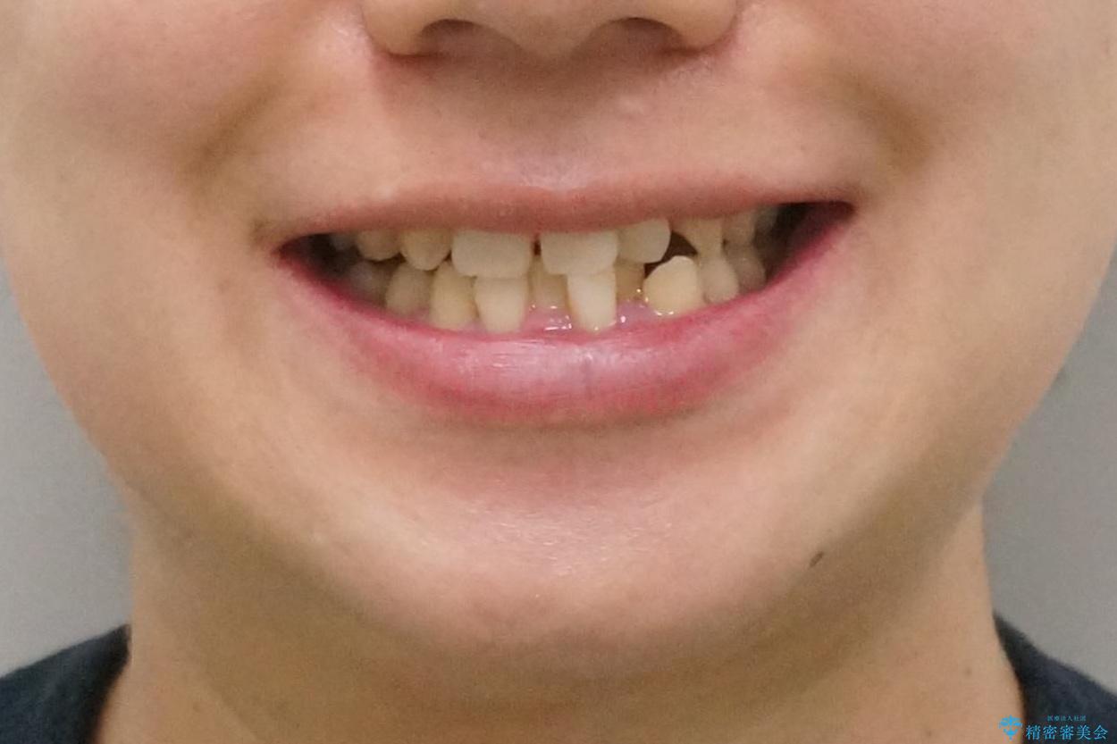 前歯のすき間 歯のがたつきの治療前(顔貌)