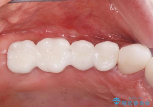 歯がずっと疼く 根本的な治療の希望の治療後