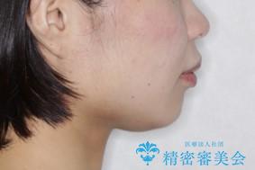 部分矯正で前歯をなおしたい→全顎ワイヤー矯正できちんと治すの治療前(顔貌)