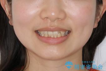 下顎前歯の先天欠損と上顎前歯のクロスバイト:インビザライン治療の治療前(顔貌)