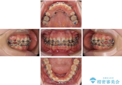 八重歯が気になる。補助装置を併用したワイヤー矯正の治療中
