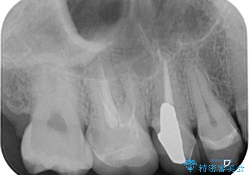 セラミックが欠けた オールセラミッククラウンの治療前