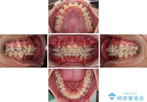 深い咬み合わせと前歯のデコボコ ワイヤー装置での抜歯矯正の治療中
