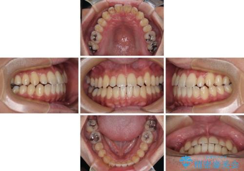 内側に引っ込んだ歯を治したい インビザラインの矯正治療の治療中