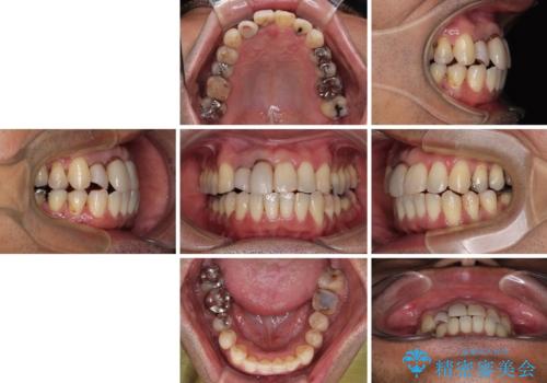 隠れている前歯 インビザライン矯正治療と前歯のセラミック治療の治療中