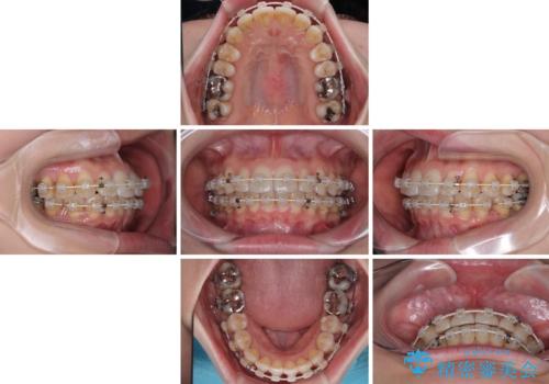 上下前歯のデコボコ ワイヤー装置で楽ちん矯正治療の治療中