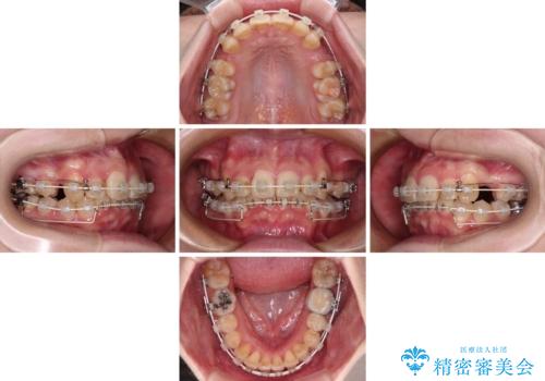 【モニター】デコボコ前歯を治したい ワイヤー装置での抜歯矯正治療の治療中