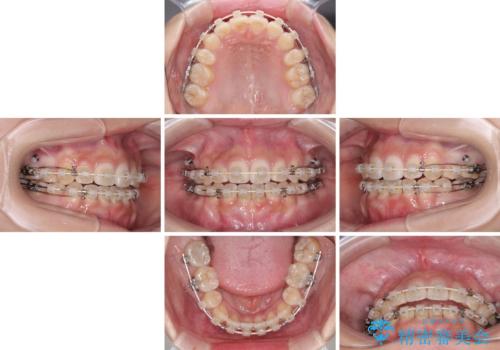 上下非接触の前歯 口元の突出感を改善する抜歯矯正の治療中