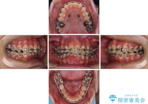 【モニター】飛び出した上の前歯 非抜歯矯正で整った口元にの治療中