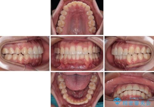 前方に捻れた前歯を治したい インビザライン矯正治療の治療中