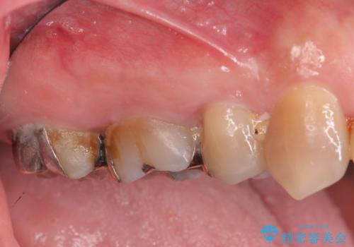 歯周ポケットの除去と再補綴治療の症例 治療前