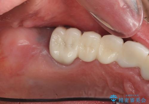 歯がずっと疼く 根本的な治療の希望の治療前