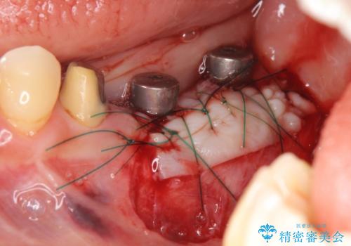 歯ブラシのしやすい環境を整えるインプラント治療の治療中