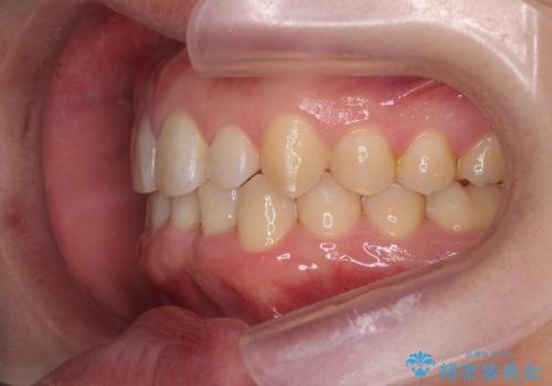 前歯のすき間 歯のがたつきの治療中