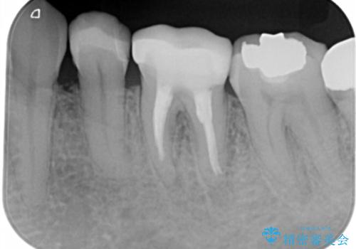 銀歯を白くしたい セラミックインレーの治療後
