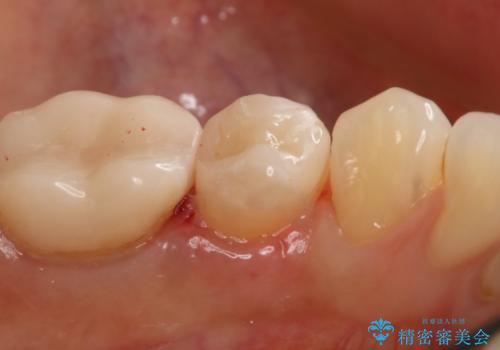 銀歯を白くしたい セラミックインレーの治療後