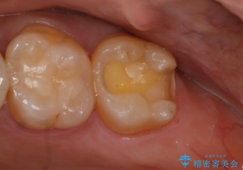 銀歯のやり変え希望 セラミックインレーの治療中