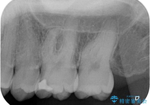 セラミックインレー 虫歯の治療の治療前