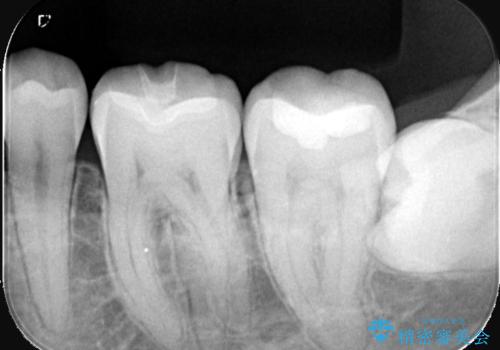 【セラミックインレー】プラスチックの劣化が気になるの治療後