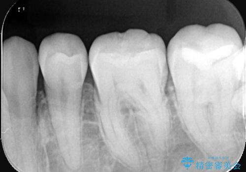 【セラミックインレー】プラスチックの劣化が気になるの治療前
