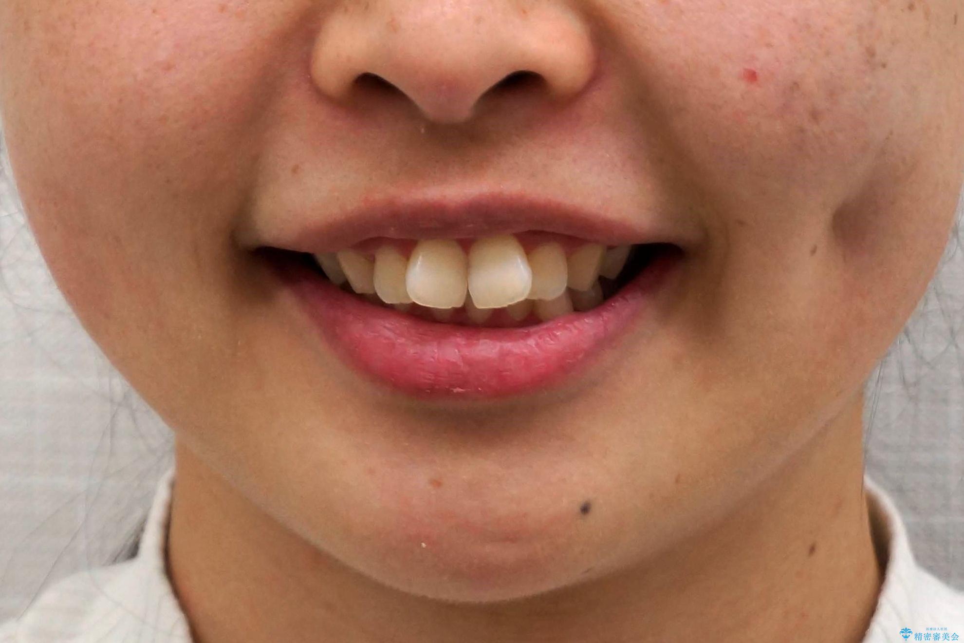 出っ歯の治療 抜かずに 短期間で目立たない治療の治療前(顔貌)