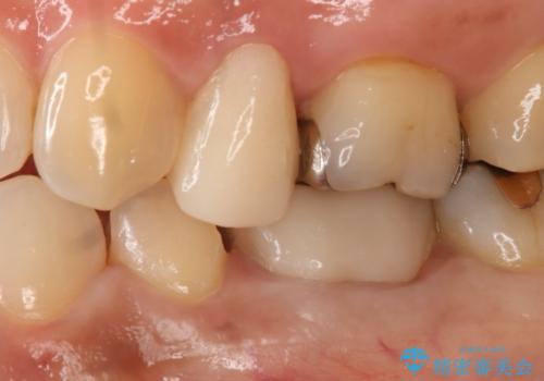 銀歯を白くしたい セラミックインレーの治療中