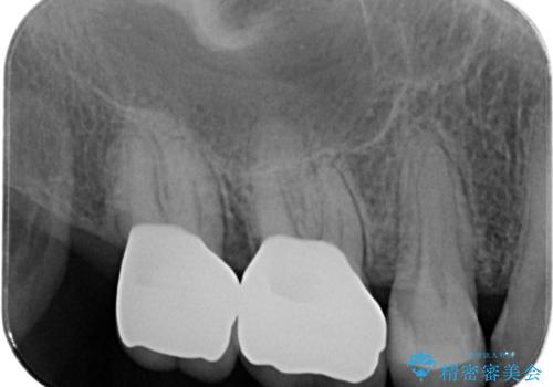 歯周ポケットの除去と再補綴治療の治療後