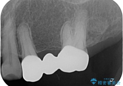 奥歯のスペースを埋めたい フルジルコニアブリッジの治療後