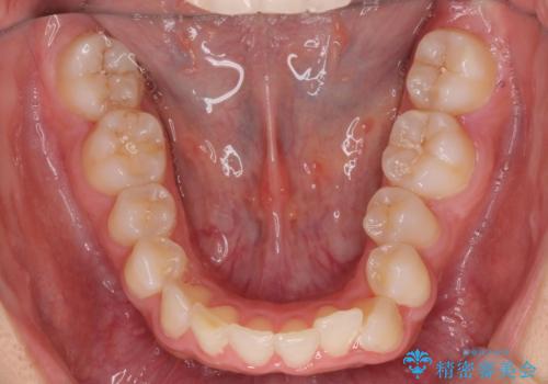 出っ歯の治療 抜かずに 短期間で目立たない治療の治療前