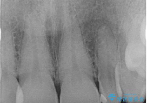 前歯が大きいのが気になる セラミックで整えたいの治療前