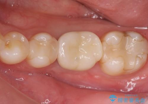 欠損部のインプラント補綴の治療後