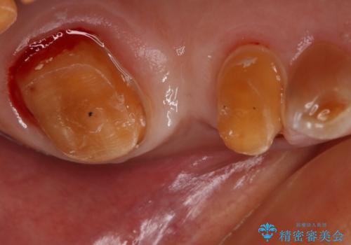 奥歯のスペースを埋めたい フルジルコニアブリッジの治療中