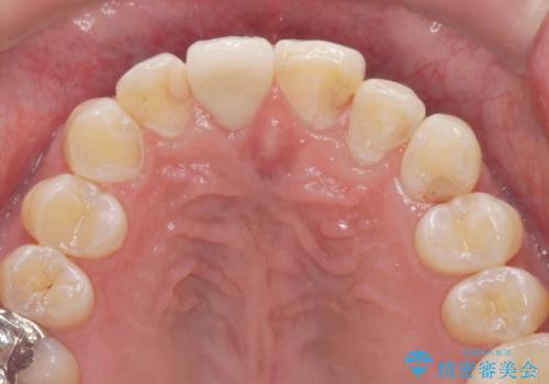 奥に引っ込んでいる前歯を並べたい 矯正治療とセラミック治療の治療後