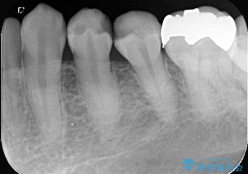 CRの劣化による虫歯|虫歯治療|セラミッククラウン|審美回復|神経を残す治療の治療前