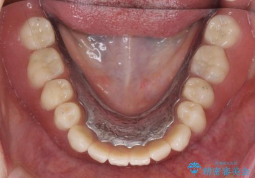 入れ歯が揺れて食事しにくい(インプラント支台義歯)の治療)の症例 治療後