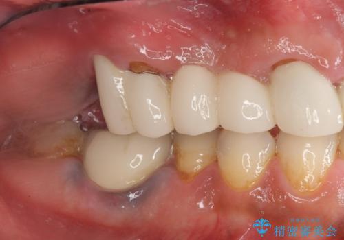 歯がずっと疼く 根本的な治療の希望の治療前