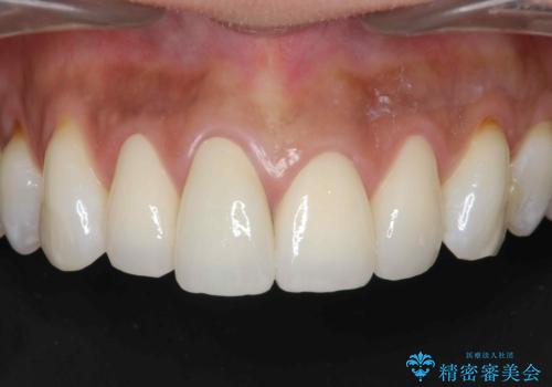 金属色の見える前歯 オールセラミックで審美治療の症例 治療後